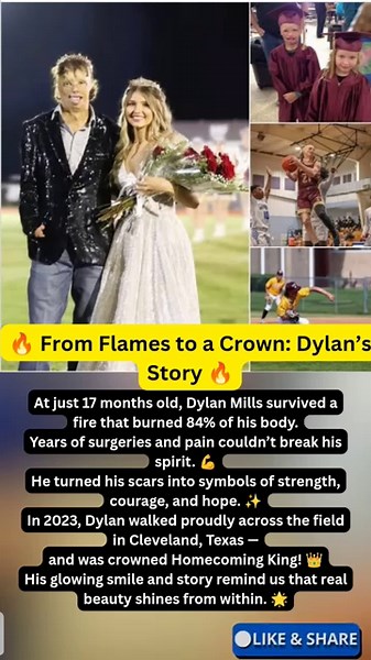 From Burn Survivor to Homecoming King! Dylan’s Incredible Comeback Story