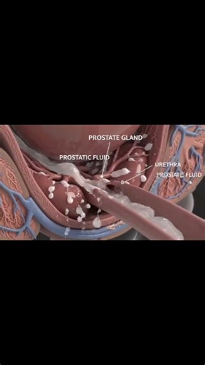 “BPH vs Prostate Cancer — Know the Real Medical Difference short part 2