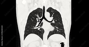 Footage of CT chest scan showing detailed lung and heart anatomy. Demonstrates advanced radiology technology for precise diagnosis and modern medical imaging innovation.