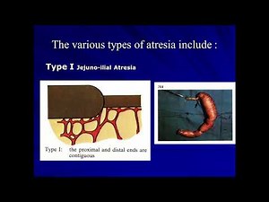 Lec.10 ( Part 5 ) | Surgery Major [Group C] (Dr. Ra'ad) | Jejunoileal Atresia + Malrotation Volvulus