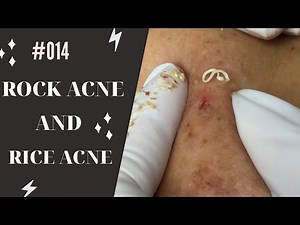 ROCK ACNE AND RICE ACNE | Mụn đá và mụn gạo | Spa Linh Mun Acne Treatment