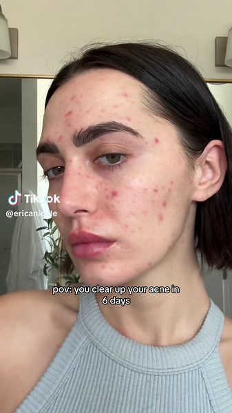 Clear Skin Secrets: Battle Acne & Flare-ups with Expert Tips