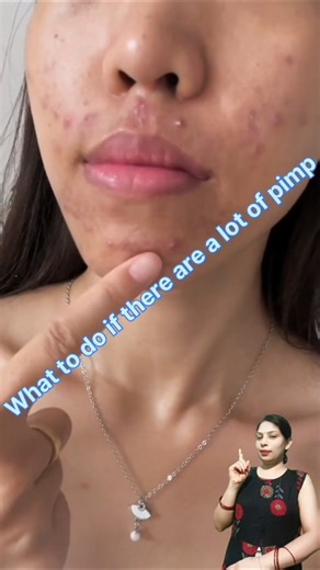 I have a lot of pimples on my face, what should I do? #skincare #beautifulskin #skinfairness #shorts