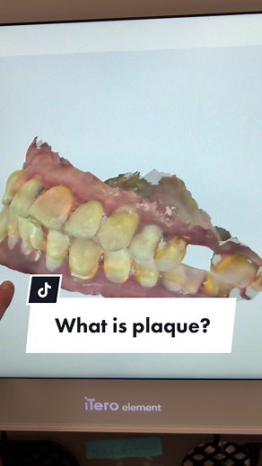 Understanding Plaque: Causes, Removal, and Prevention