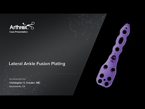 Lateral Ankle Fusion Plating