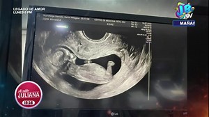 1.2M views · 8.2K reactions | #ATVNoticias #AlEstiloJuliana | Se comparó la ecografía de una reportera de nuestro equipo con la imagen que Gabriela Sevilla compartió en sus redes sociales con el fin de buscar diferencias. Mira el programa completo en nuestra web ATV.pe | ATV Noticias Perú | Facebook