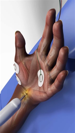 A nerve conduction study measures how fast electrical signals travel through your nerves to detect damage or compression. Sticky electrodes are placed along the skin, and a brief electrical pulse stimulates the nerve while a computer records how quickly the signal moves. Healthy nerves transmit signals rapidly, while slower speeds may indicate irritation, injury, or conditions like carpal tunnel syndrome. #NerveConductionStudy #Neurology #NervePain #3DMedicalAnimation #MedicalAnimation #PatientE
