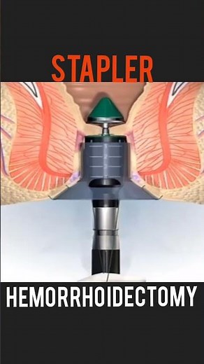 Stapler Hemorrhoidectomy