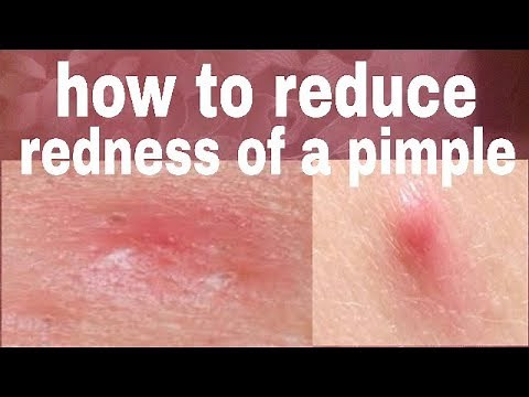 How to reduce the redness of a pimple easily