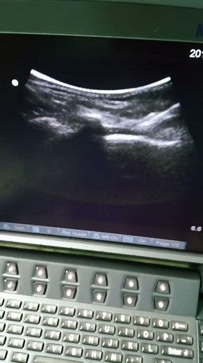 Ultrasound guided caudal Injection