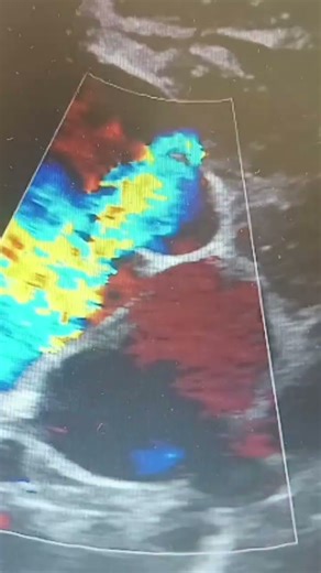 ASD with bi directional shunt.