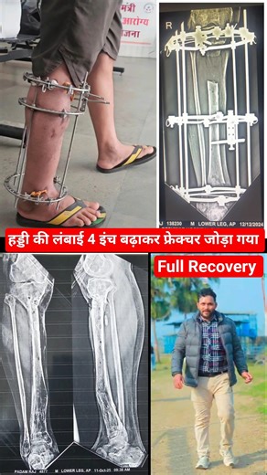 Full Recovery Journey by Ilizarov Surgery In Tibia bone fracture infected nonunion