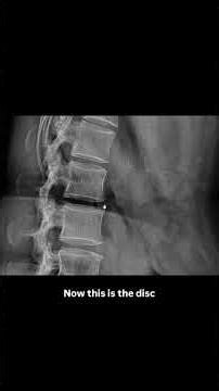 How to Read an LS Spine X-Ray | Lateral View | Normal Anatomy Explained