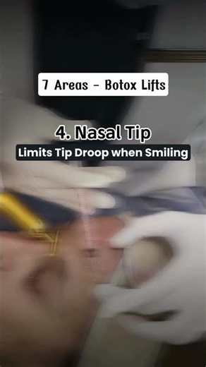 7 Botox Lift Areas That Subtly Refresh Your Face ✨💉