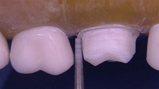PFM Preparation on The Maxillary First Molar for #3 Kilgore
