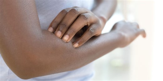 Think You Have Stress Hives? These Photos Will Help You Figure It Out