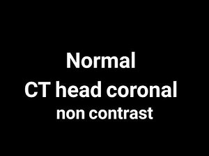 Normal CT head.Non contrast.Coronal