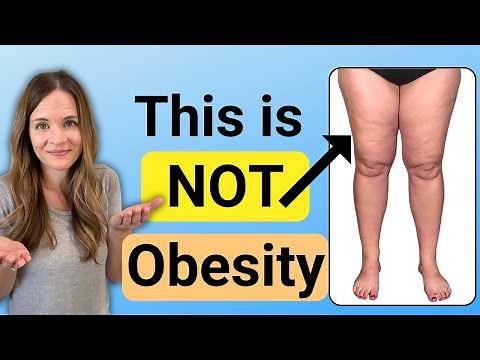 Lipedema. Is it Fat or Swelling?