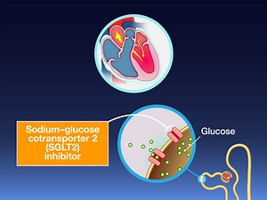 Guidelines recommend SGLT2 inhibitors for patients with heart failure and an ejection fraction of 40% or less, but benefits in those with a higher EF are less certain. New research findings are summarized in a short video. https://nej.md/3Bm8ucu | The New England Journal of Medicine
