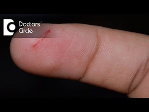 How to manage pain after cut injury on finger with no associated bleeding? - Dr. Sanjay Gupta