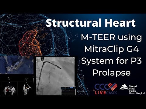 M-TEER using MitraClip G4 System for P3 Prolapse