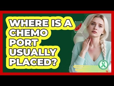 Where Is A Chemo Port Usually Placed?
