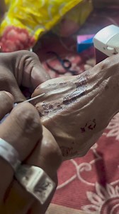 136K views · 714 reactions | Cannulation processfollow  #hospital #medicalprocedure #doctor #medicalstudent #hospital #nursing #hospitalstaff #hospitaltraining | Dr.mhmedical | Facebook