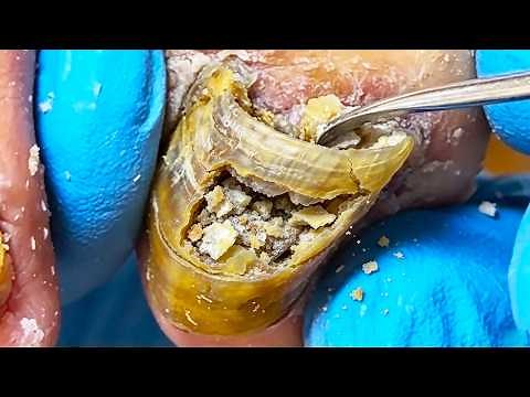 Strange Onychomycosis, Quick Treatment In Seconds!【Xue Yidao】