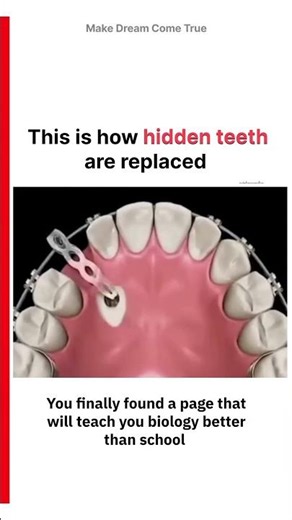 🦷This is how 😬 hidden teeth are replaced | MDCT