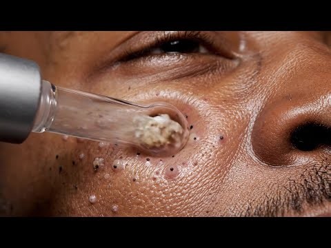 Blackhead Extraction Close-Up | Nose Cleaning