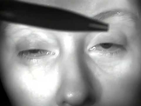 Chronic Progressive External Ophthalmoplegia (CPEO)_Moran_5-34