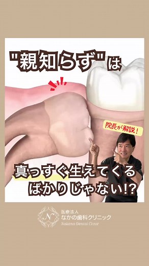 親知らずの抜歯と歯科相談の重要性