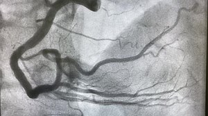 Coronary Angiogram Show Normal Right Coronary Stock Footage Video (100% Royalty-free) 1087258595 | Shutterstock