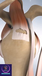 399K views · 1.3K reactions | Rotator cuff rupture surgery #rotatorcuff #medical #3danimation #foryou | Medical Animation Media | Facebook