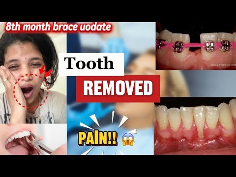 "They Removed My Tooth !!! 😱& 8th Month BracesJourney | Extraction Experience"