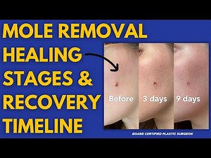 Mole Removal Healing Stages & Recovery Timeline