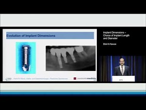 Implant Dimensions – Choice of Implant Length and Diameter | Bilal Al-Nawas