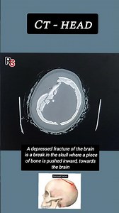 depressed fracture of brain ll CT SCAN #headinjury #radiology #trauma #radiographer