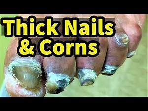 Thick Nails & Corns: Diabetic with Fungal Toenails and Corns