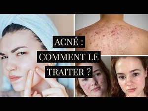 ACNE (CAUSES, TYPES, TREATMENT, PREVENTION)
