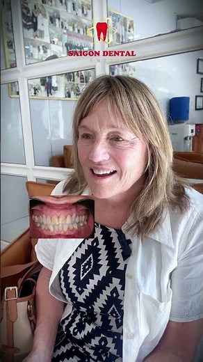 Dental veneer placement for two misaligned front teeth #dentalveneers #dentist