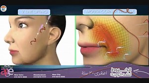 263K views · 970 reactions | #اصغرى_عشرين_سنة !! دلوقتى تقدرى ترجعى شباب ونجمة احلى من زمان عن طريق #الخيوط_الفرنسية لشد الوجه فى اسرع وقت اقل من 15 دقيقة من غير اى الم وتنطلقى بعدها بروح جديدة وشكل جذاب وكل ده هاتشوفيه بنفسك اثناء الجلسة :) | Nouvel Âge Clinics | Facebook