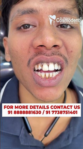 "Dental Implant Temporary Tooth Cap – The Perfect Implant Solution at Dr. Richa Cosmodent! 🦷✨"