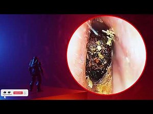 The Truth About earwax Will Shock You. How to remove earwax from ear, earwax extractions