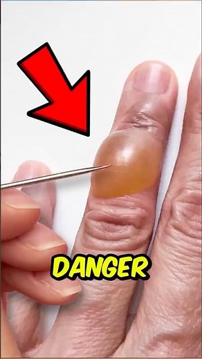Why You Should NEVER Pop a BLISTER😱