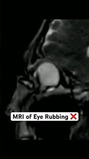 Stop Rubbing Your Eyes 😳