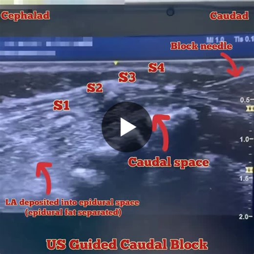 Ultrasound guided caudal epidural block performed in a paediatric patient undergoing bilateral inguinal hernia repair. Ropivacaine 0.25% (1 ml/kg) administered via the caudal epidural space… | Mohd Syafiq Shokery