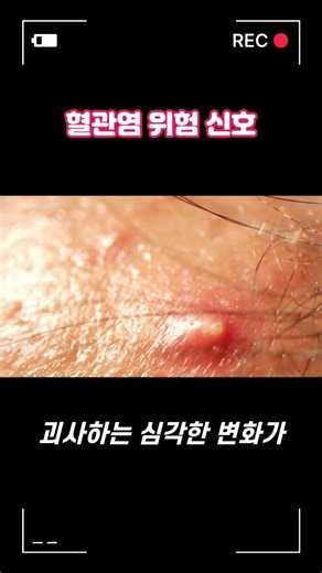 "붉은 반점이 생기고 몸살 기운이 계속된다면?" 혈관염 위험 신호