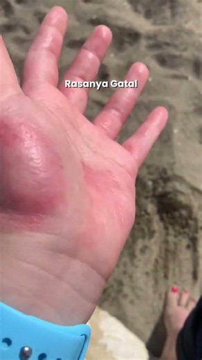 How to Treat Itchy, Weeping Eczema