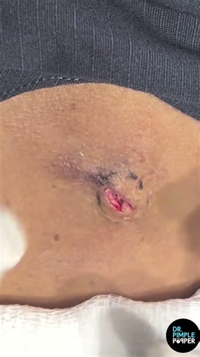 Dr. Pimple Popper vs. Inflamed Recurring Cyst